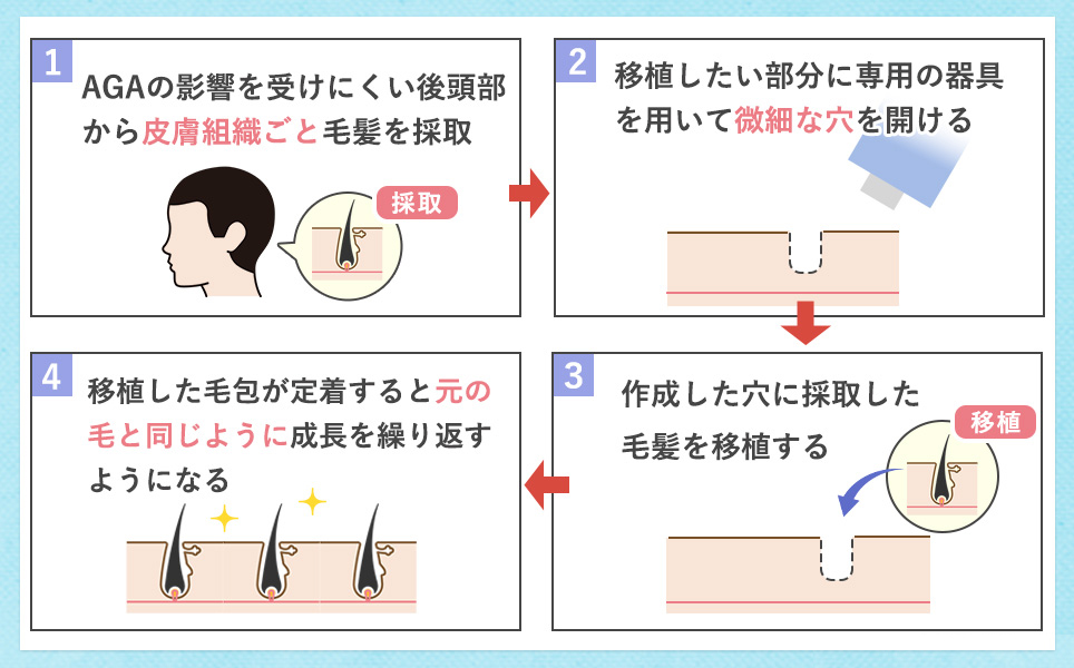 自毛植毛の仕組みについて