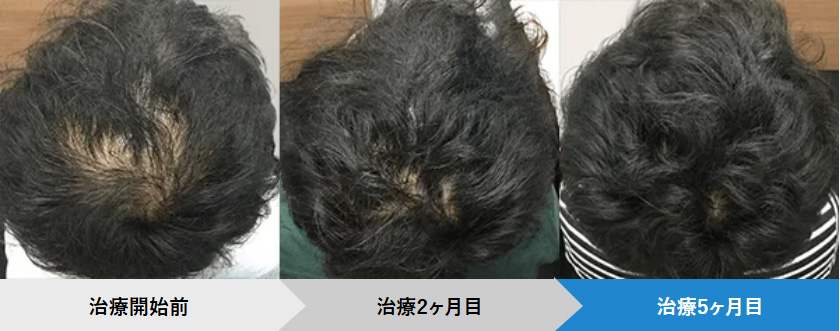 AGAヘアクリの症例写真:26歳