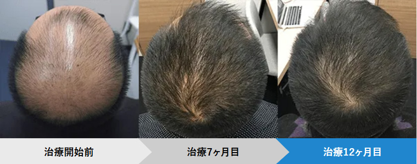 AGAヘアクリの症例写真:36歳