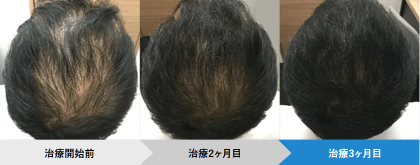 AGAヘアクリの症例写真:46歳