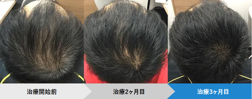 AGAヘアクリの症例写真:50歳
