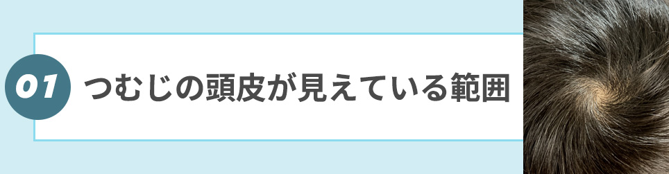 1. つむじの頭皮が見えている範囲