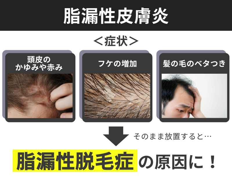 脂漏性皮膚炎が脂漏性脱毛症の原因になる
