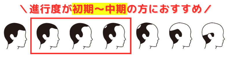 AGA治療薬_フィナステリドは進行初期〜中期がおすすめ