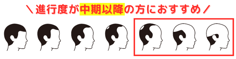 AGA治療薬_ミノキシジルは進行中期以降がおすすめ