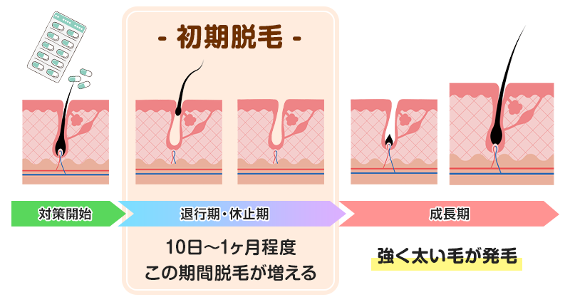 初期脱毛はAGA治療での発毛に必要なプロセス解説