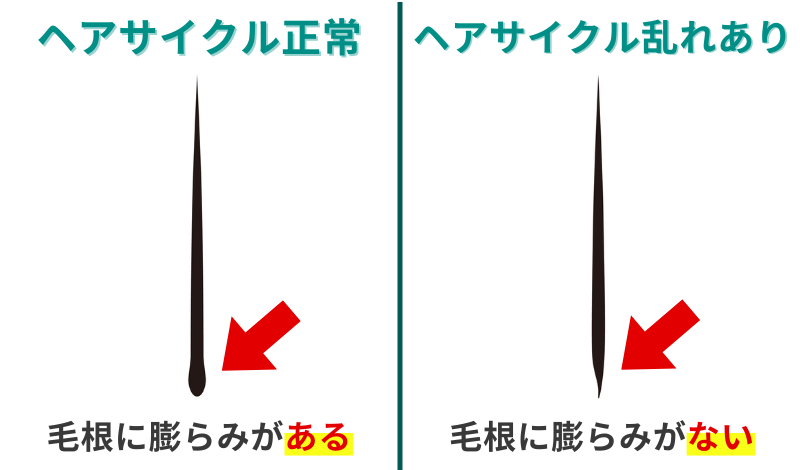 ヘアサイクルが正常な毛根と乱れた毛根の比較