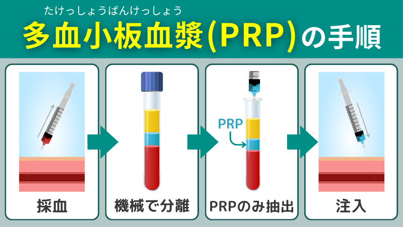 多血小板血漿の手順画像