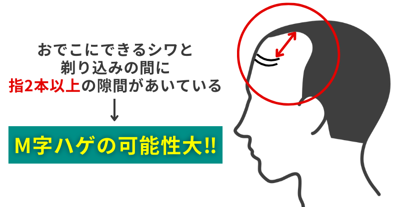 AGA_M字ハゲの判断基準