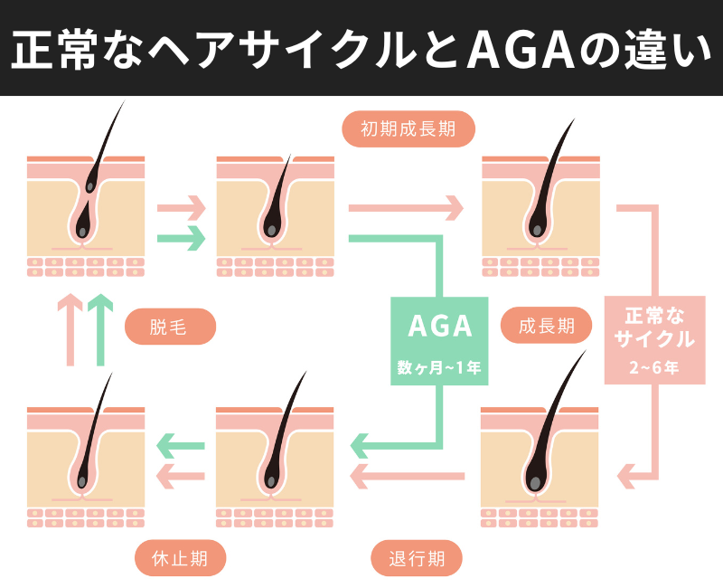 正常なヘアサイクルとAGAの違いの図