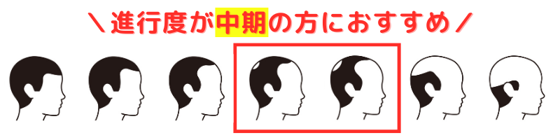 AGA治療薬-デュタステリドは進行中期がおすすめ