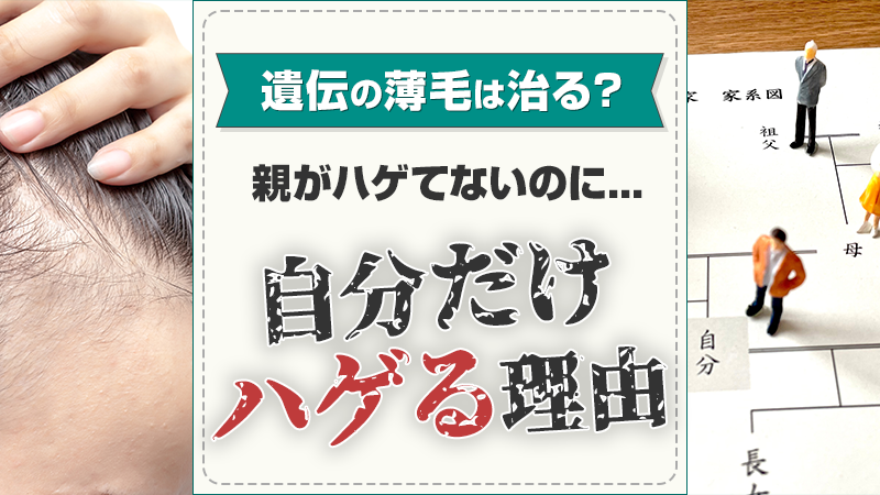 親がハゲていないのに自分だけハゲる理由